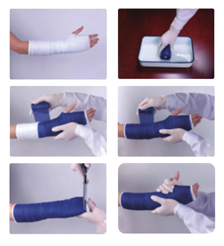 خطوات استخدام شريط صب العظام